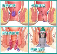 美国PPH痔疮环切术 一次性解决痔疮“复发”难题。